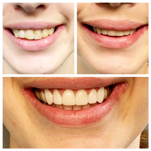 before after