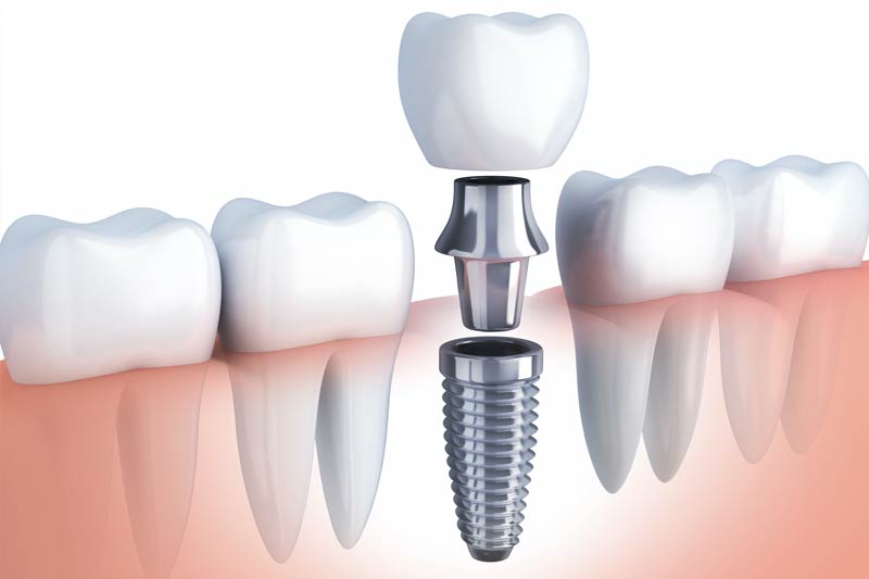dental implants2