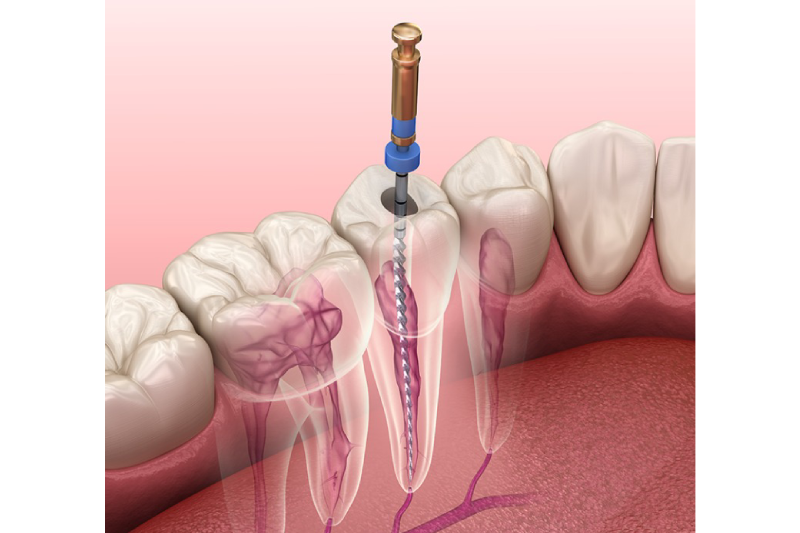 root canal